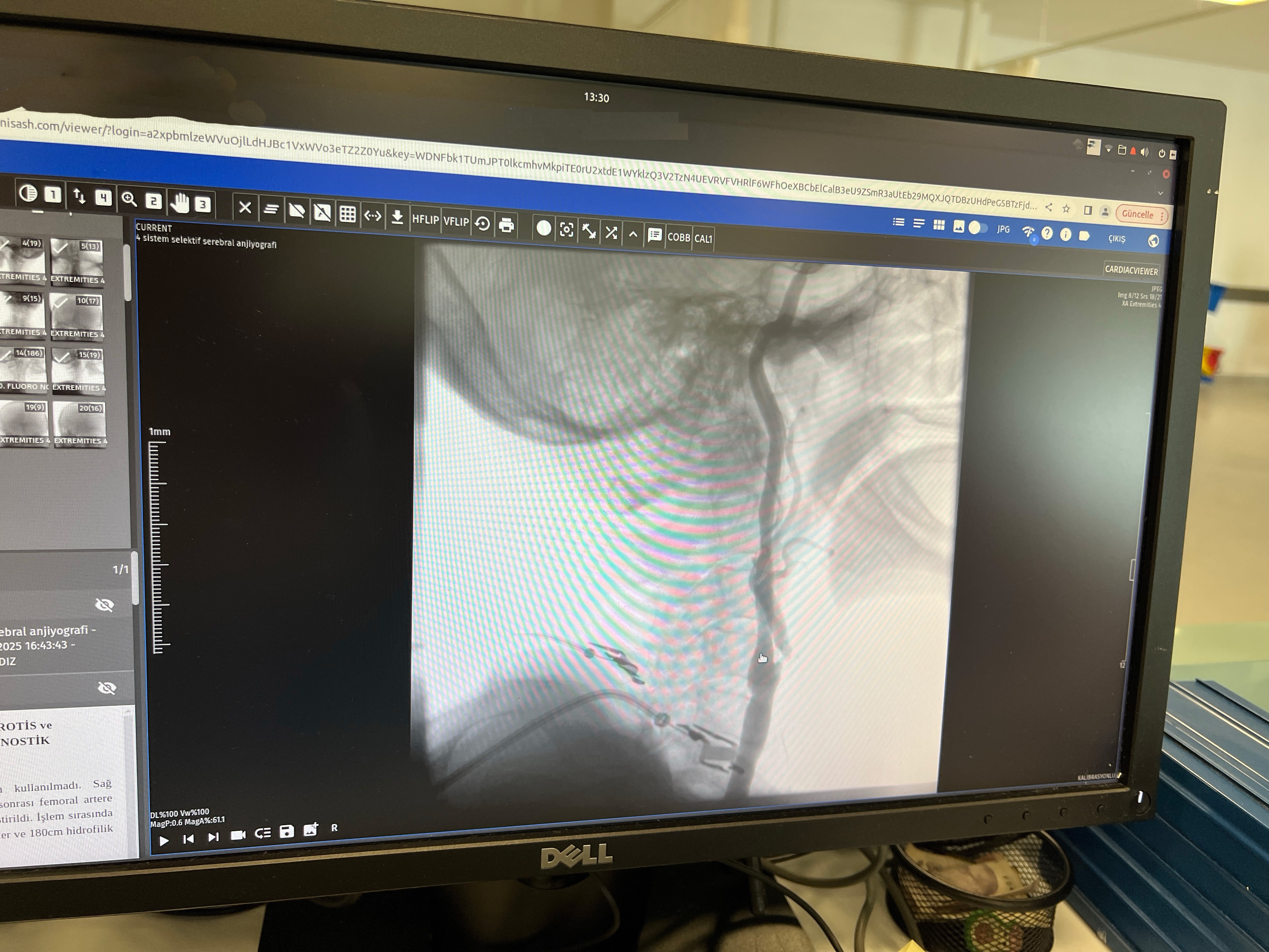 Manisa Şehir Hastanesi’nde modern çözüm: Ameliyatsız stent dönemi