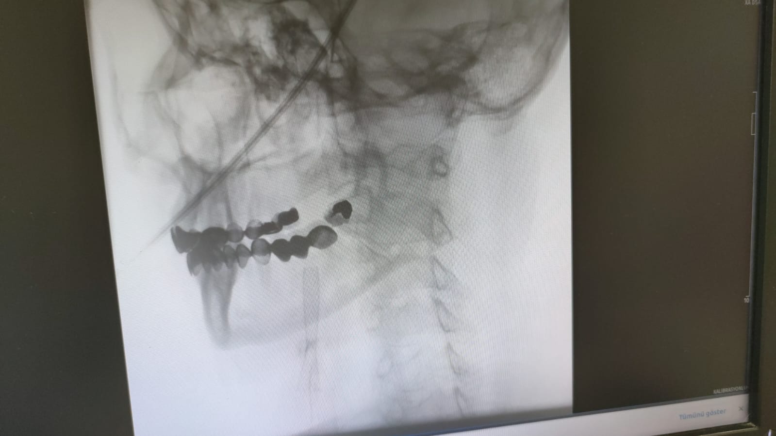 Manisa Şehir Hastanesi’nde modern çözüm: Ameliyatsız stent dönemi