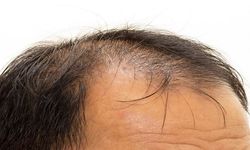 Saç Kök Hücre Tedavisi