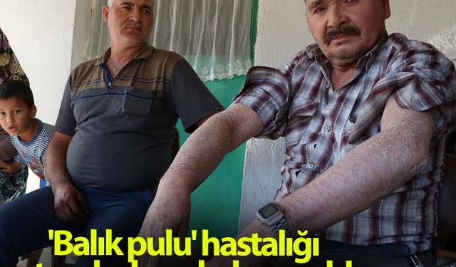 'Balık pulu' hastalığı vatandaşların kabusu oldu