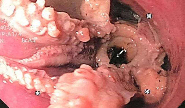 Yutkunamayan adamın yemek borusundan öyle bir şey çıktı ki...